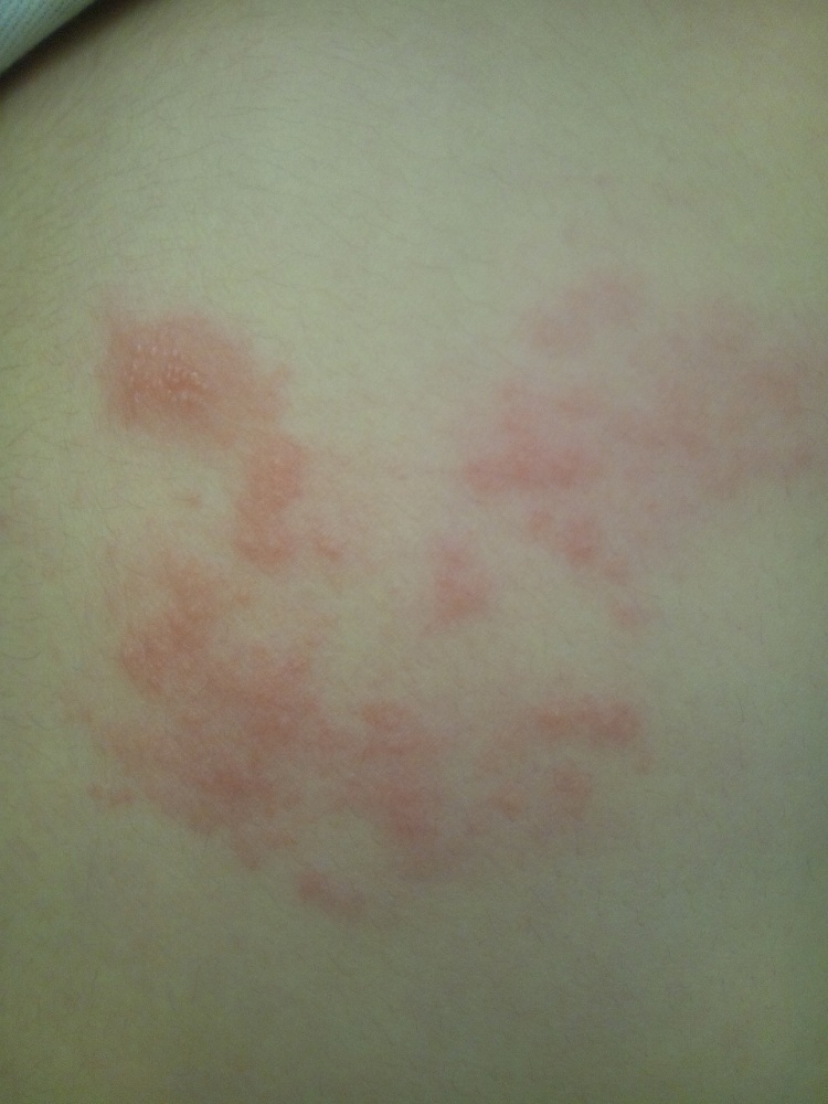 画像付き 帯状疱疹の初期症状とは？帯状疱疹予防.jp