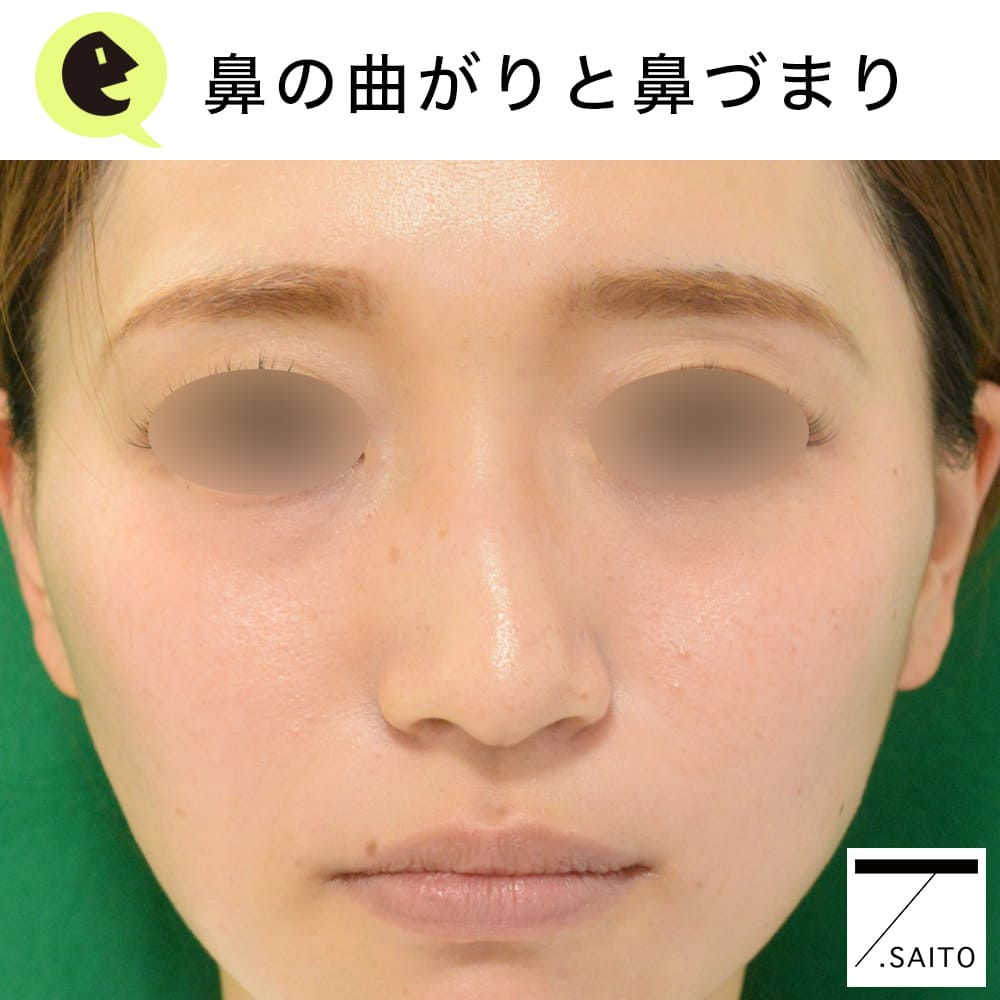 斜鼻 鼻の曲がりや歪み の施術 診療案内マックスファクス銀座クリニック