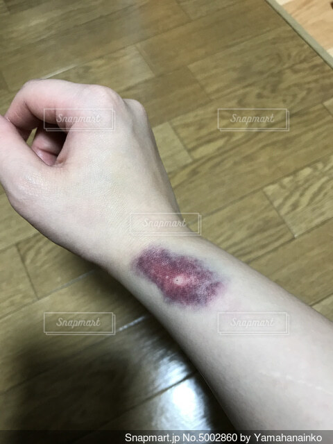 脂肪吸引のダウンタイム〜辛い・痛いを早く治す方法