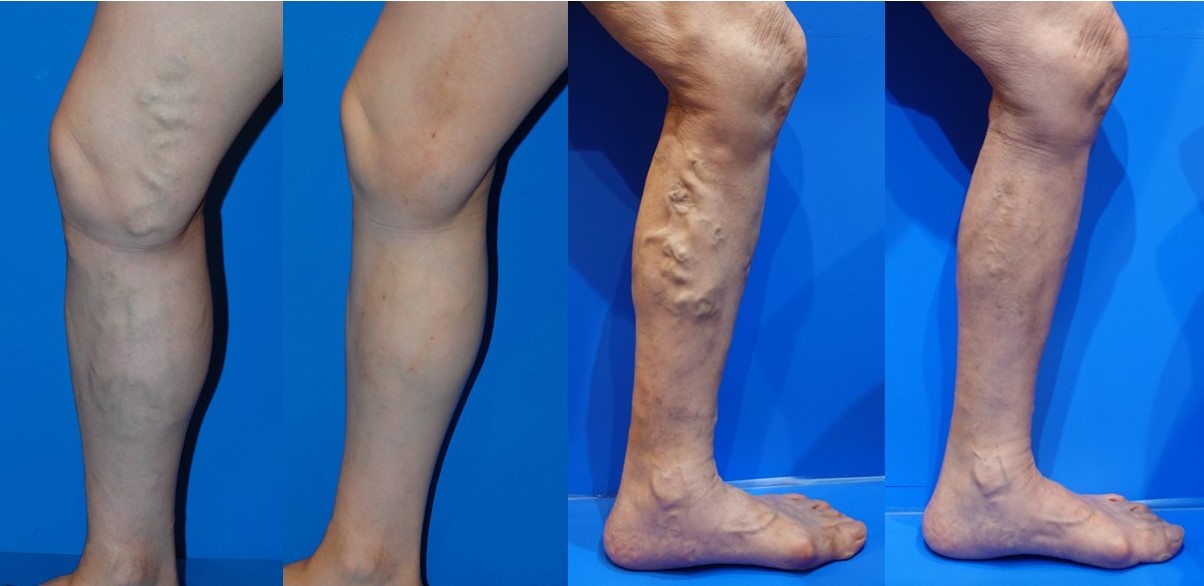 脚をボトックスで細くする - 東京 渋谷 美容皮膚科 マグノリア皮膚科クリニック