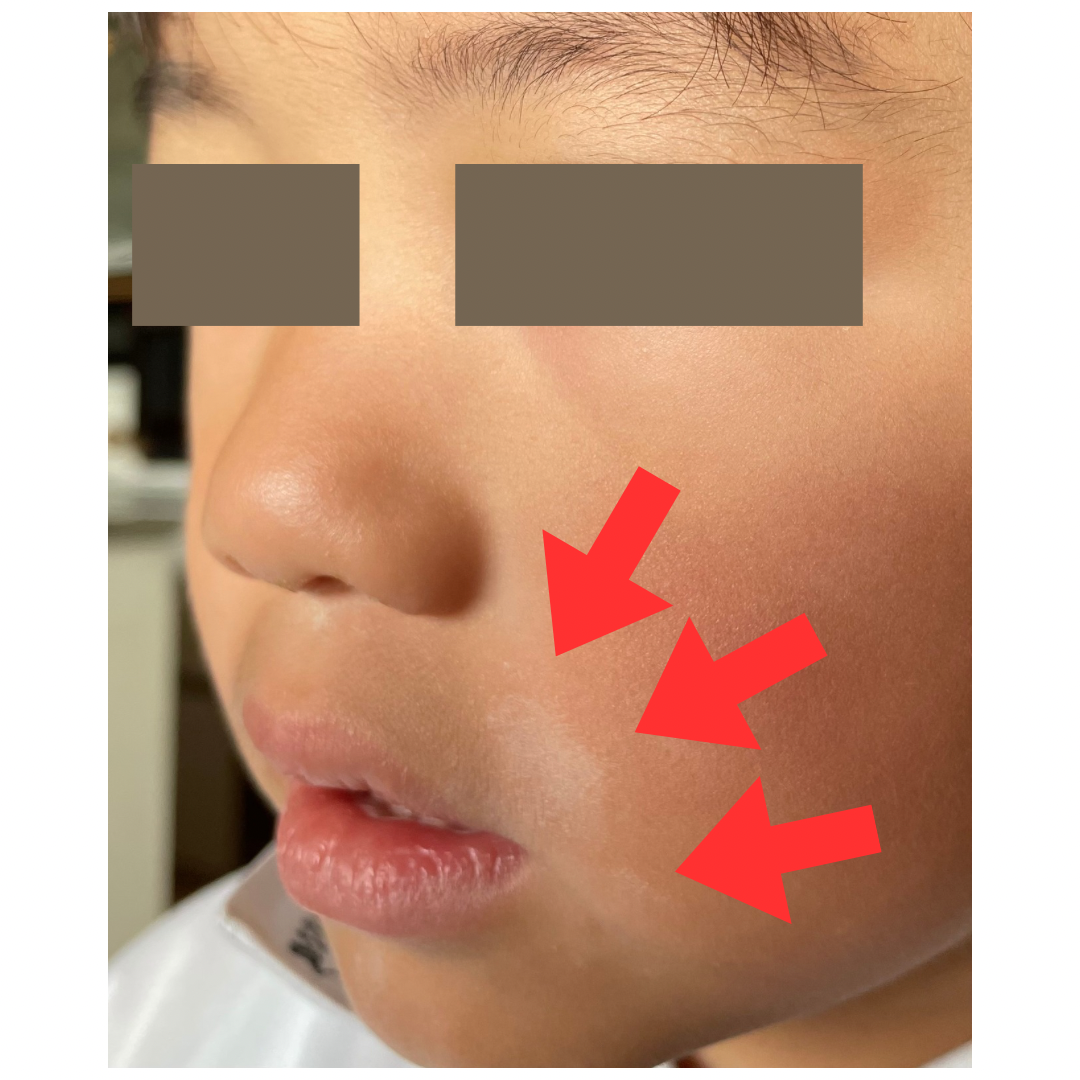 新生児黄疸は危険？ 1ヶ月健診 までに起こりやすい２大トラブルを医師が解説！たまひよ