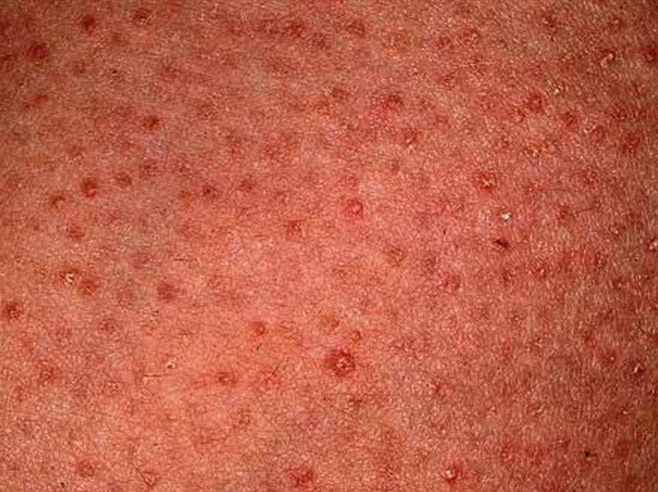 ステロイド歴30年以上 苔癬化 たいせんか した全身の皮膚炎が改善 入院期間：2015年7月～11月：症例23アトピー脱ステロイド専門入院自然療法『ナチュラルクリニック21』