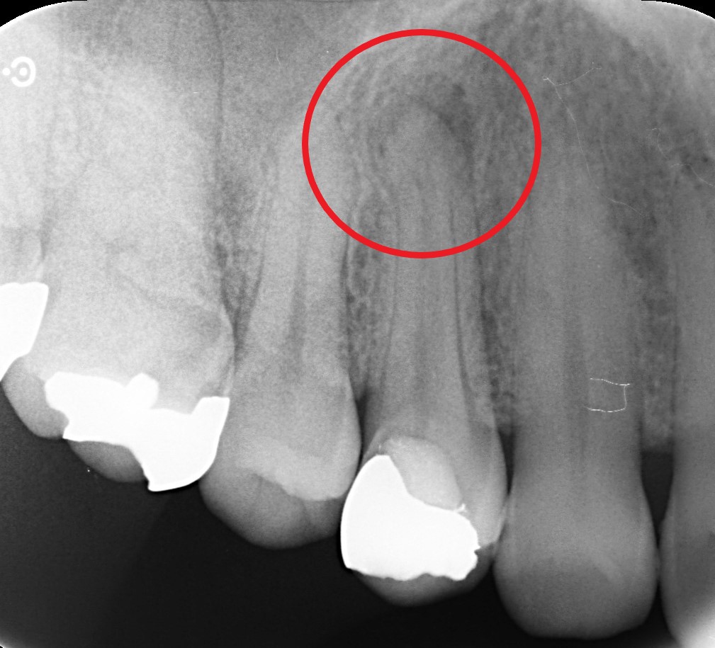 歯の横に膿ができたら？治し方は？ばんどう歯科・矯正歯科