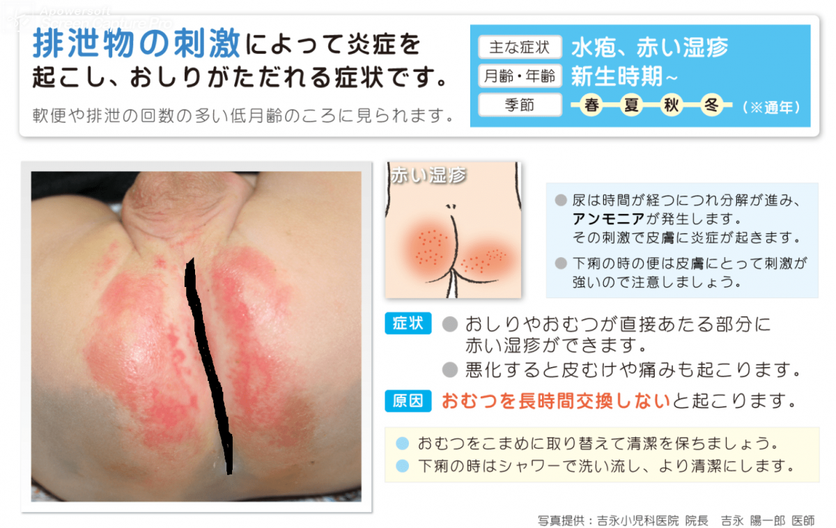 足の親指の皮むけについて 赤ちゃんの心と体 ベビーカレンダー専門家相談