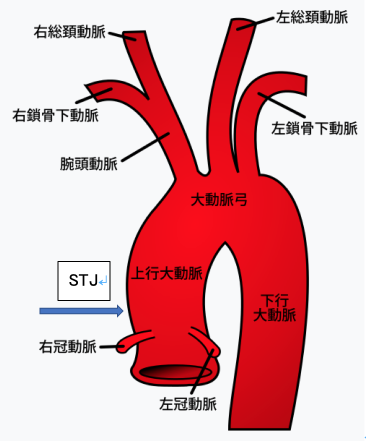 生命にかかわる大動脈解離は救急医療の連携がカギとなる