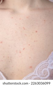 胸ニキビができる原因と予防法衣類の擦れや蒸れに注意with BEAUTY