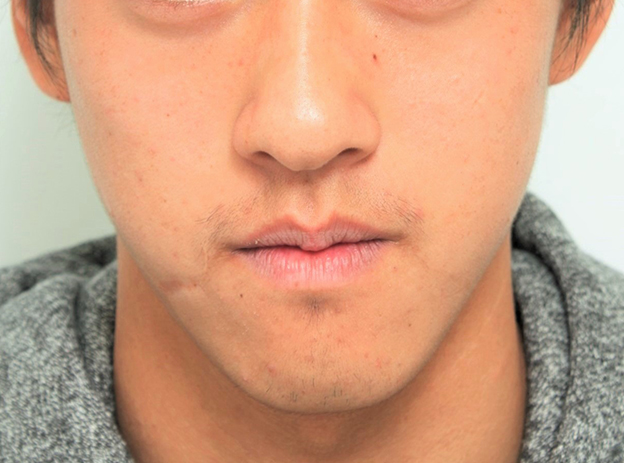 顔に傷がある美しい若い女性のクローズアップ肖像画Premium写真