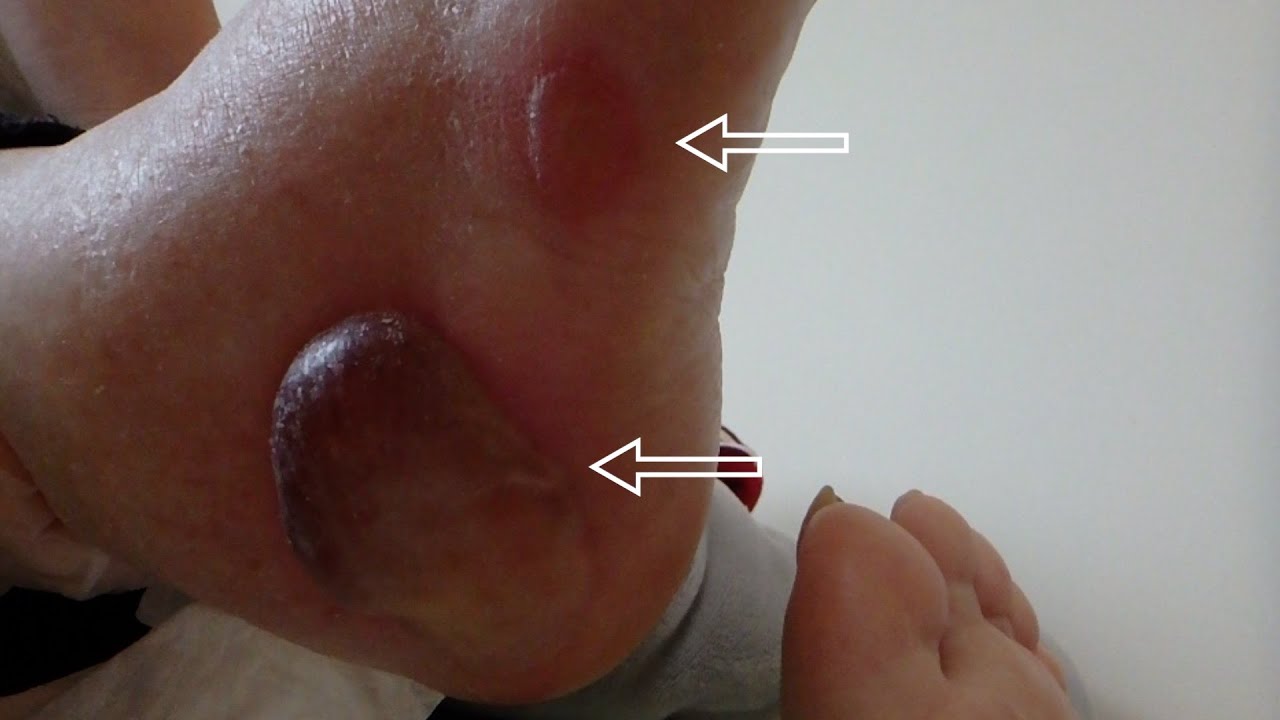 浮腫みからの水ぶくれが破裂 - 自己満足な日記or備忘録 akayamaqueen