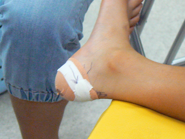 楽天市場80 手で切れる ふわふわ 伸縮 保護 テープ テーピング 靴擦れ 外反母趾 内反小趾 足裏 指 マメ タコ 魚の目 巻き爪 関節 保護ソフト 5m 1巻 25mm 肌色 黒 白 全3色 : 公式 外反母趾専門本舗 楽天市場店