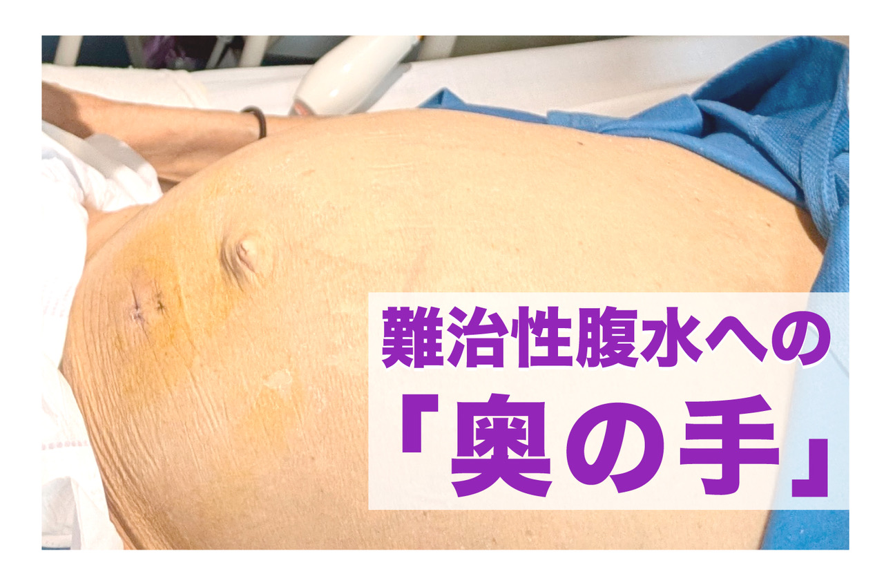 お腹が膨満している その4—腹水のフィジカル—病歴と視診・打診から腹水貯留をみつけよう！medicina 60巻2号医書.jp