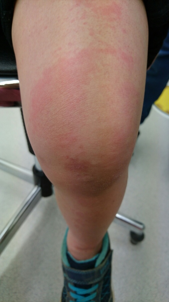 あせもの治療 大人・子ども 墨田区 曳舟泌尿器・皮ふ科クリニック