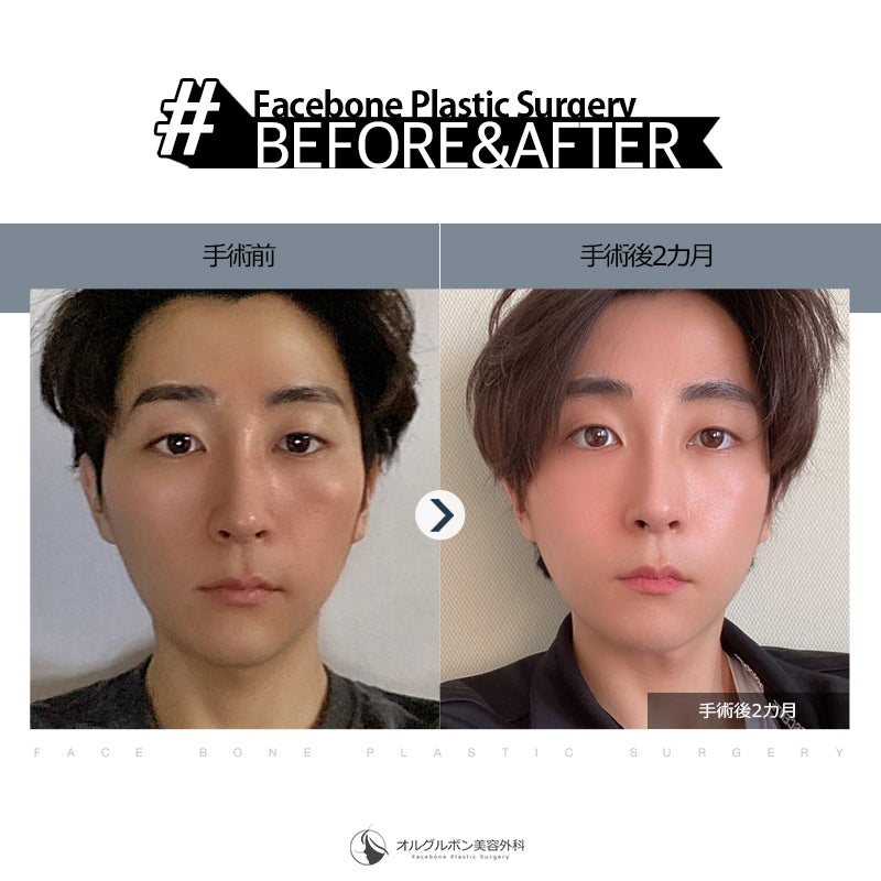 頬骨骨切り・骨削り・縮小頬骨整形・小顔・顔痩せ池袋の美容皮膚科・美容外科ならみずほクリニック