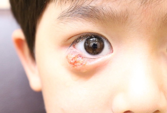 顔のまぶたが腫れている野田市 小児科 千葉県 こどもの花粉症 こどもの漢方 喘息 アトピー性皮膚炎 アレルギー 結節性痒疹 たんぽぽこどもクリニック