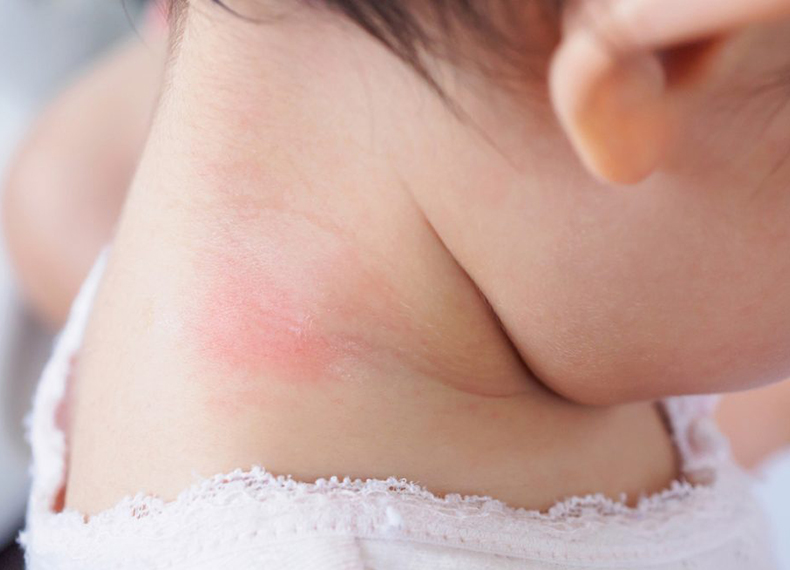 子どもに多い汗疹 あせも とは？原因・症状・治療法・予防法も生活クラブ共済連