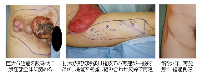 線維腫の切除 – 吉祥寺 歯医者 – さくま歯科