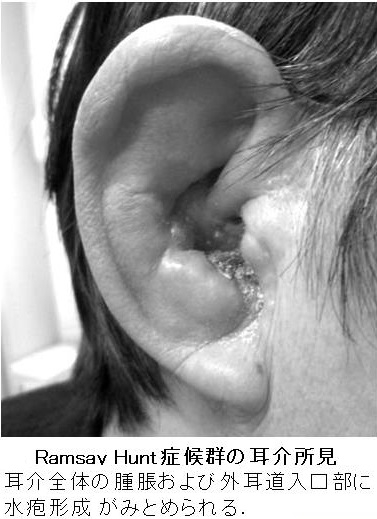 医師監修・作成 帯状疱疹の画像7点：初期症状のかゆみ、赤み、水ぶくれとかさぶたMEDLEY メドレー