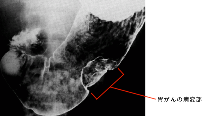 胃カメラでわかる病気内視鏡・堺 ましも内科・眼科クリニック 胃カメラ・大腸カメラ