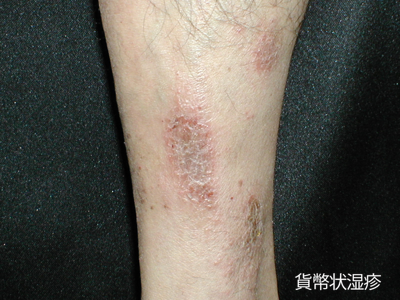 アレルギーについて接触皮膚炎 - アレルギーポータル