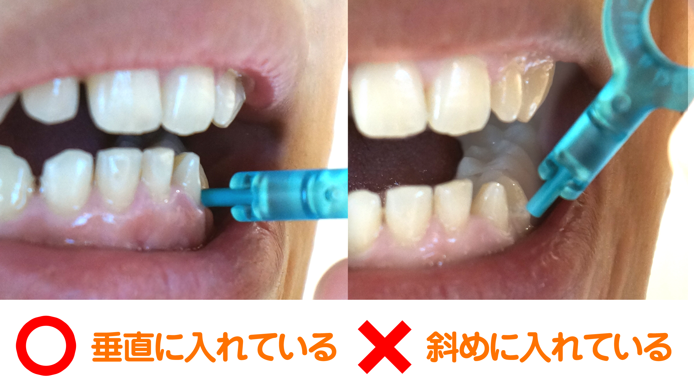 奥歯がにおうのはなぜ？ 歯科医が解説する6つの理由と対処法 – 秋田市のハピネス歯科ブログ