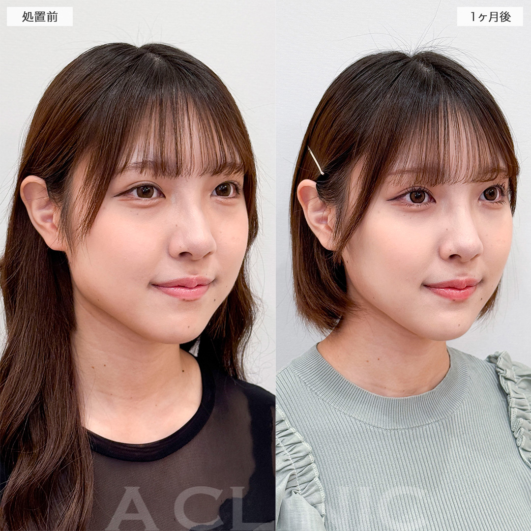 顔が平面だと思ったらチェックすべきポイント３つ - 小顔矯正・整体を東京でお探しならRevision