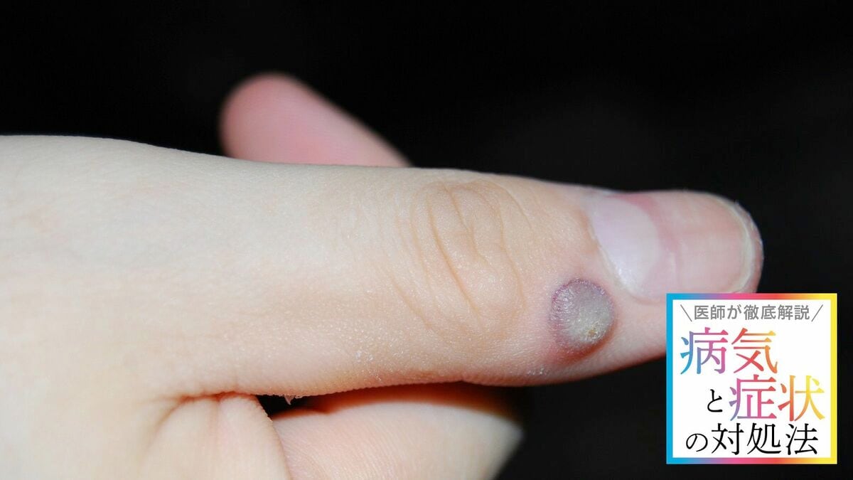 イボの種類背中・足・手の甲などにできる原因あさ美皮フ科亀戸駅前