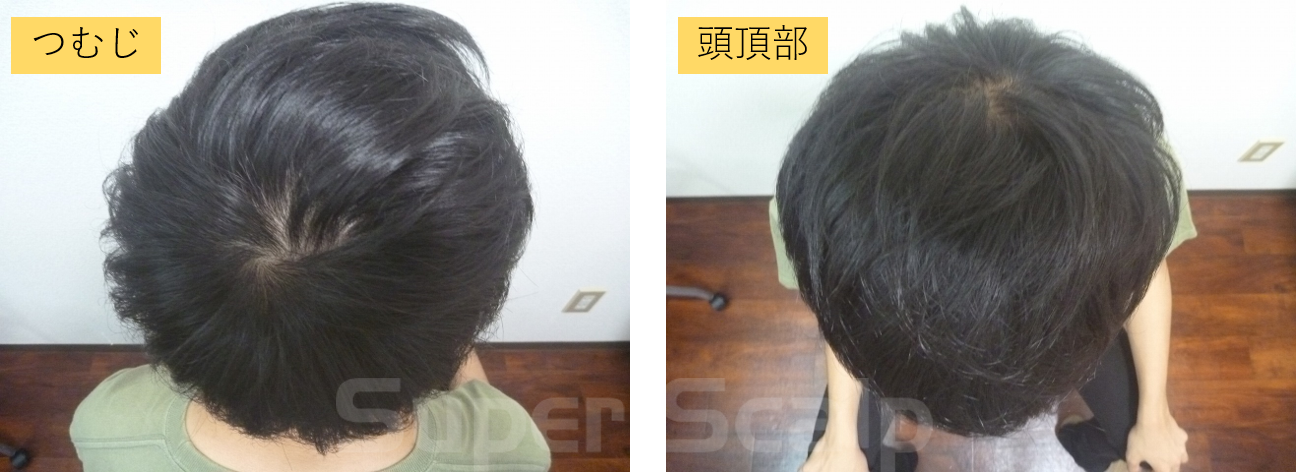 まだ高校生なのにつむじハゲ？若ハゲを上手に隠しながら改善・治療するには髪コト - 増毛から増髪へ スヴェンソン -頭髪を通じてライフスタイルを豊かにするための情報を発信AGA・ハゲ・円形脱毛症のお悩み