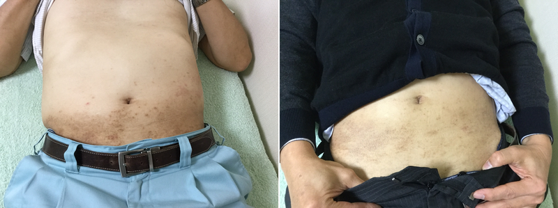 あせも」の1.2万点のロイヤリティフリー画像、写真素材、絵Shutterstock