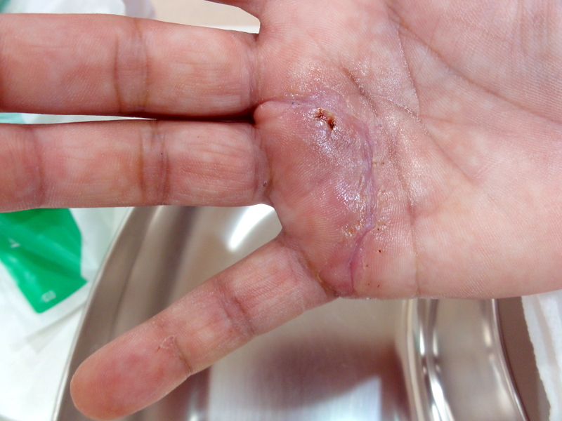 皮膚がん 皮膚科当院で扱っているがんの種類がんセンター大阪医療センタ