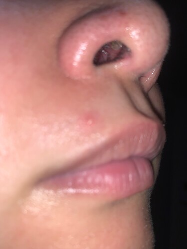 写真あり 鼻の下や顎にできる吹き出物の正体と原因を教えて Q&A - @cosme アットコスメ
