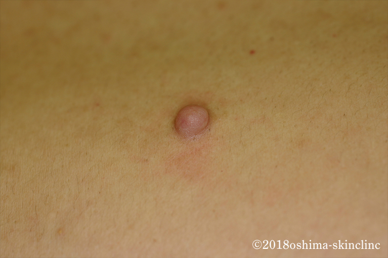 二の腕の皮膚線維腫を切除。術後1年3か月目。かなりきれいになりました。豊洲佐藤クリニック