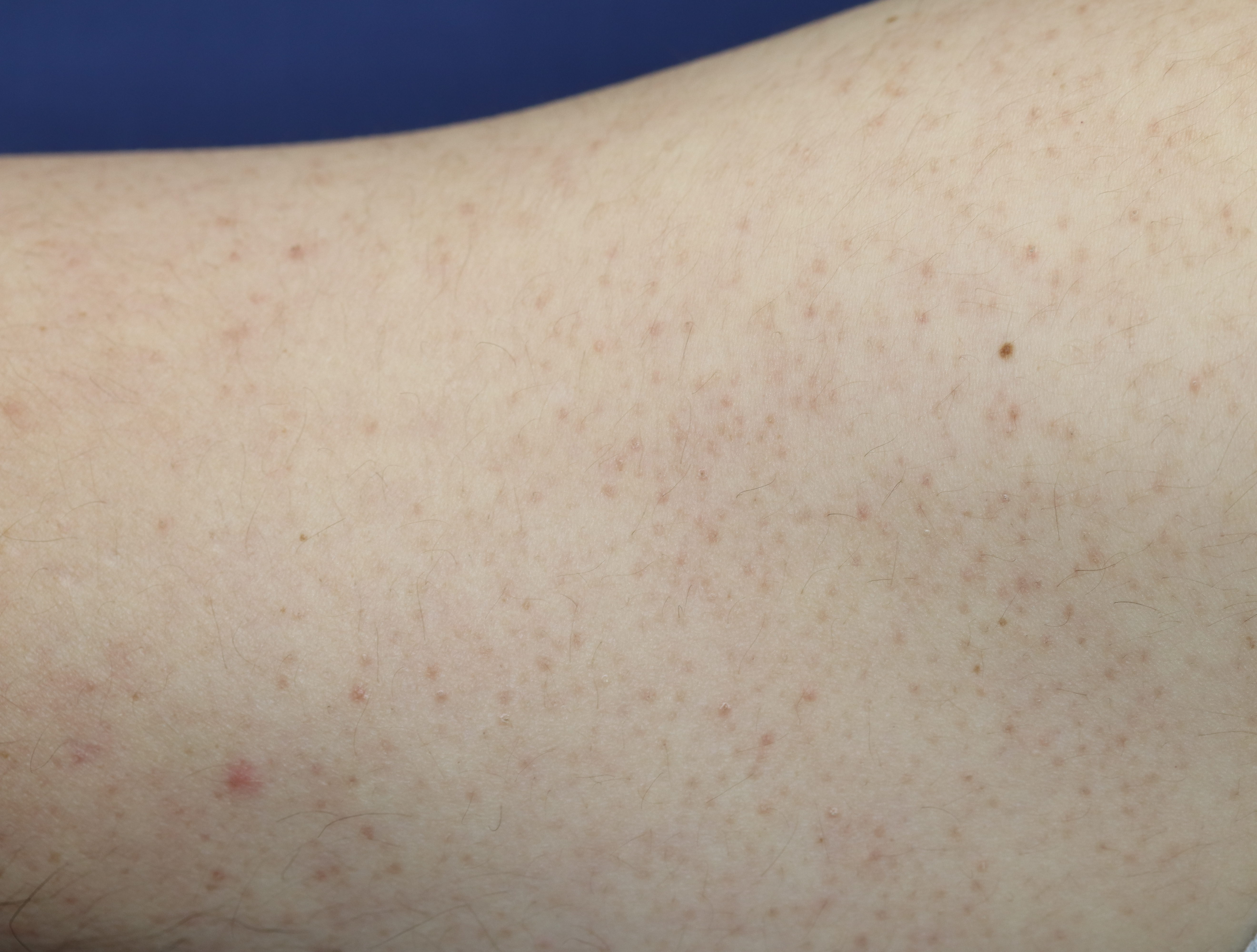 知ってた？ これは毛孔性角化症ではありません