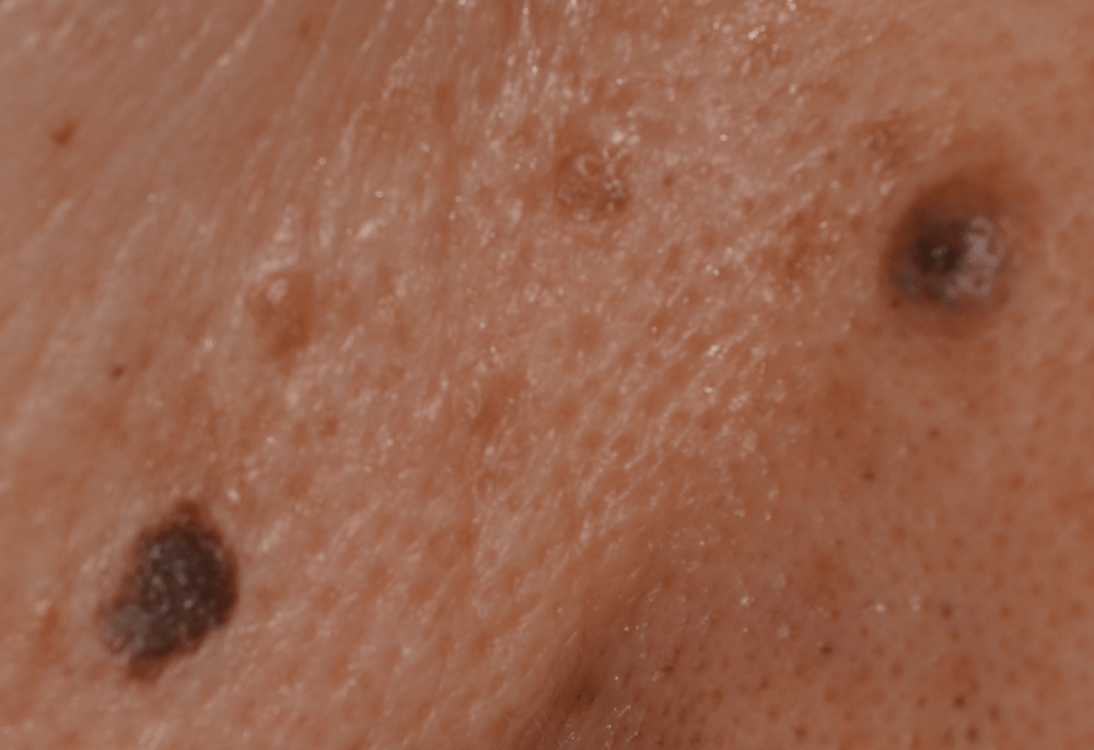 首の吹き出物について 画像あり- 数ヶ月前から首にニキビ Q&A - @cosme アットコスメ