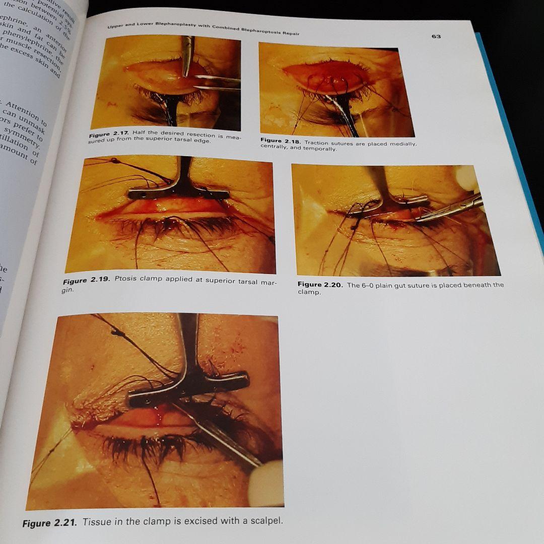 美容眼瞼下垂手術テキスト 英語版第2弾 美容外科の名医が教える「