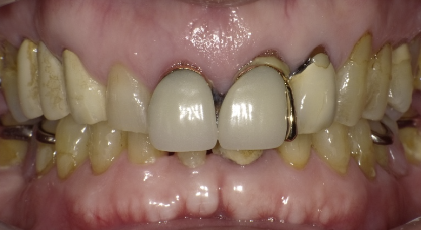前歯にインプラントを行い10年以上経過した症例大阪府豊中市の「ますだ歯科医院」インプラント専門サイト