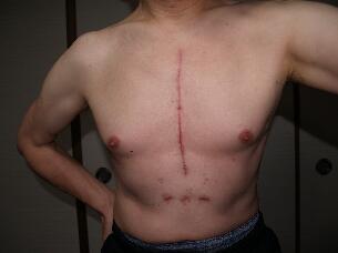 心臓手術体験記僧帽弁閉鎖不全症弁形成術術後の誕生日＆手術創の写真