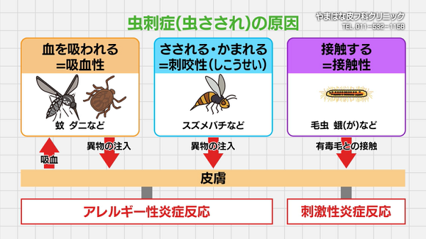 虫さされチェックアース害虫駆除なんでも事典