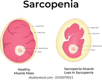 サルコペニアのイラスト素材 - PIXTA