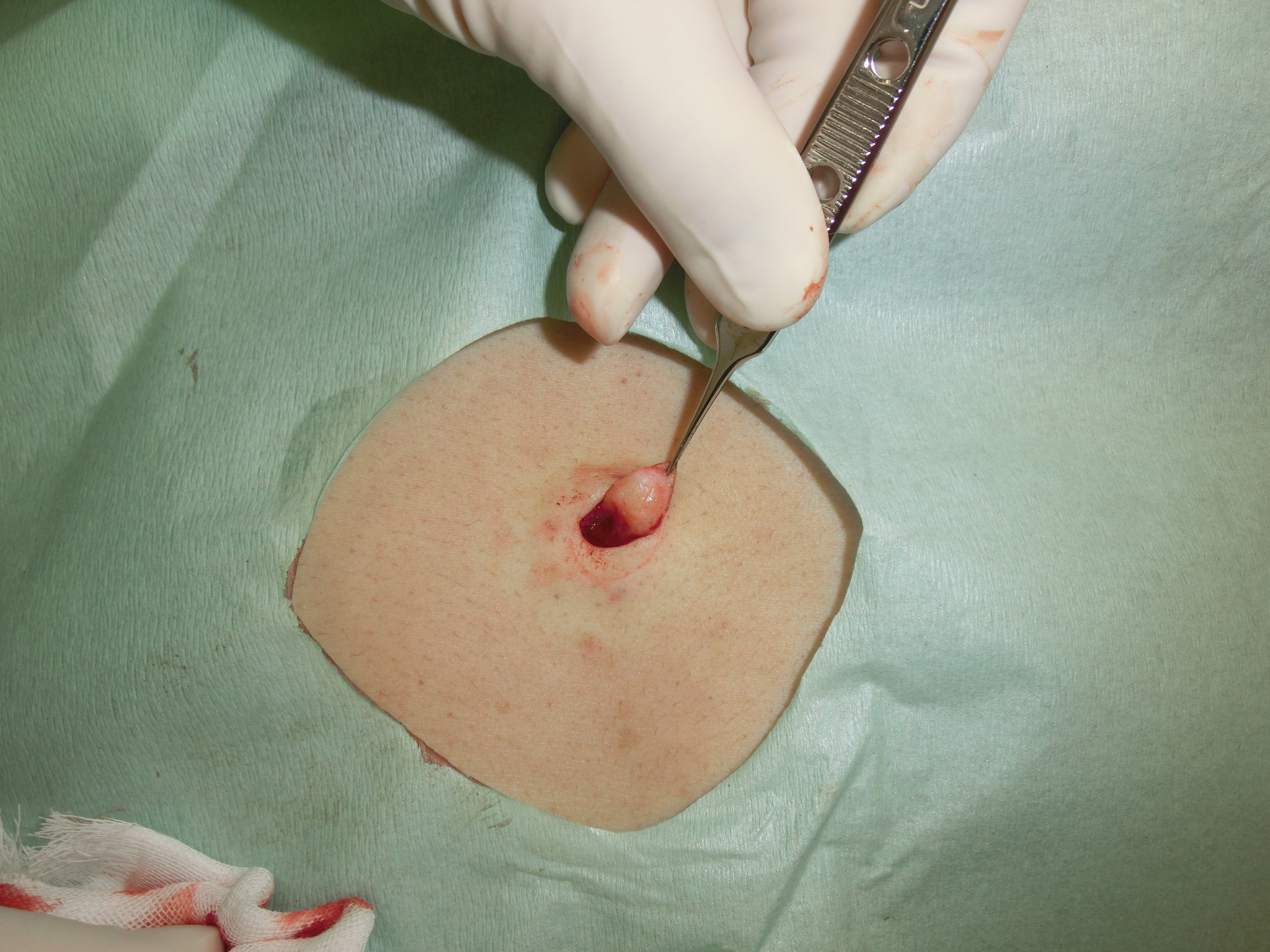 陰部 デリケートゾーン のできもの・しこり原因となる病気の特徴を解説エナ女性クリニック日本橋