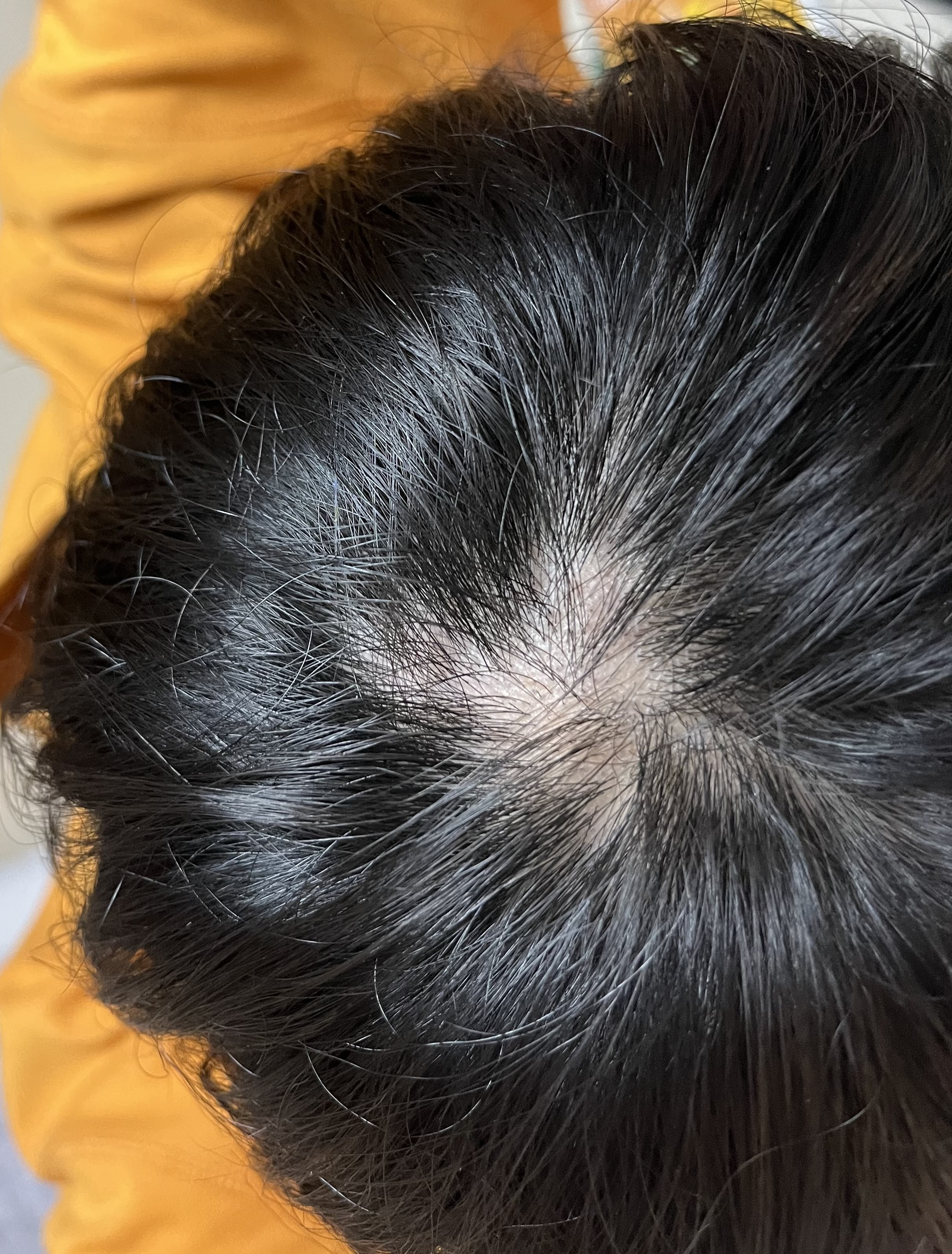 どこからつむじハゲ？男性と女性の基準や見分け方を写真・画像で解説吉祥寺でAGA・薄毛治療ならスーパースカルプ発毛センター吉祥寺駅前店 公式