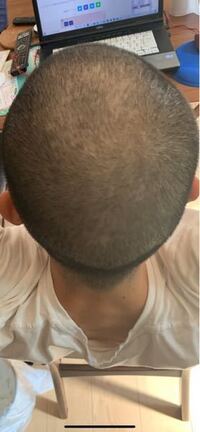 ボウズだと、ハゲにくいって本当？ヘアケアアカデミ