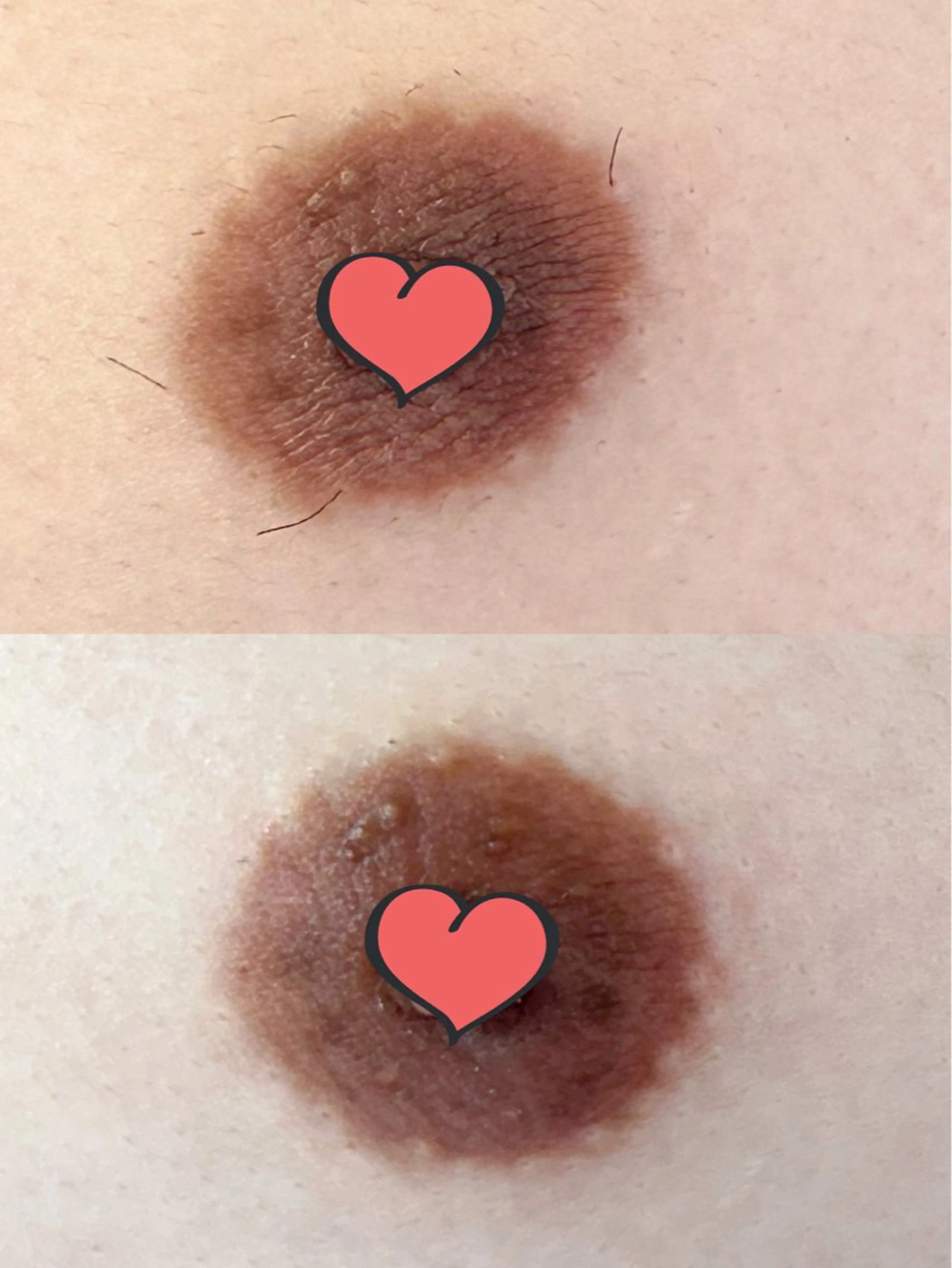 あなたの乳頭は何タイプ？バストトップの形を4種類に分けて解説！失敗・後悔したくない方必見！東京で乳首 乳頭 の整形「乳頭縮小術」ならSBC銀座一丁目院- 銀座一丁目院