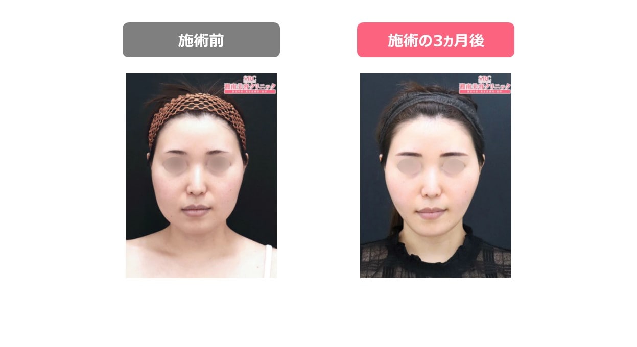 生まれつきが原因の頬肉の厚みは、頬肉の脂肪吸引で対策できます輪郭形成・小顔整形 コラム池袋の小顔整形・顔痩せ・輪郭整形みずほクリニック