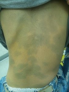 成人後の発症も増加。「アトピー性皮膚炎」。Ginseng 2015年 晩夏号研究開発室