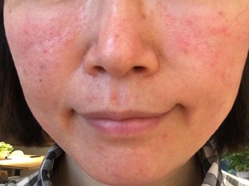 顔面・耳・首の小水疱皮膚トラブルの状態チェックヒフシルワカル