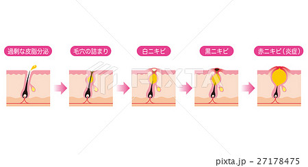 洗顔 毛穴 断面図 イラスト素材6256050- フォトライブラリ