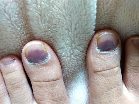 爪の内出血 血豆 は放置すると巻き爪や変形した爪になる可能性大！両国・森下ネイル&アイラッシュサロンLuz Reir ﾙｽﾚｲｰﾙ公式ホームページ