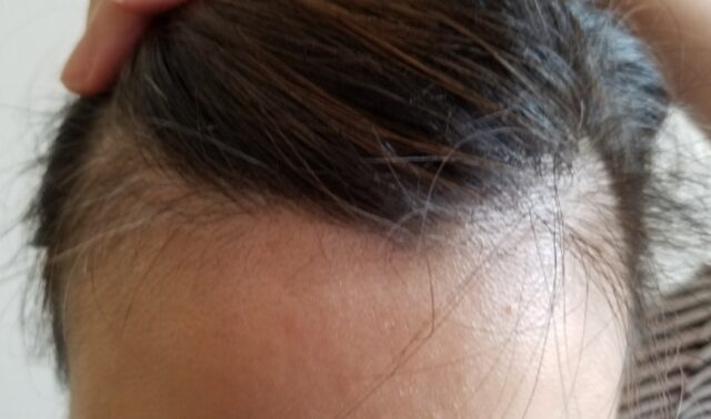 男子高校生の薄毛の対策方法を知りたい薄毛治療の