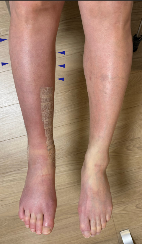 ふくらはぎを細くする治療：神経切断手術・高周波熱凝固法のリスク - 美容外科船橋中央クリニック&青山セレスクリニック