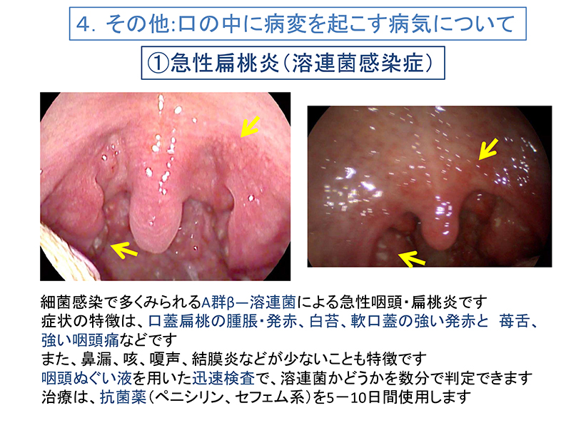 ヘルパンギーナ 感染経路、大人もうつる？ 港区の高輪マリンこどもクリニック