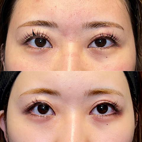 平行型二重の特徴二重・目元整形なら湘南美容クリニック 公式
